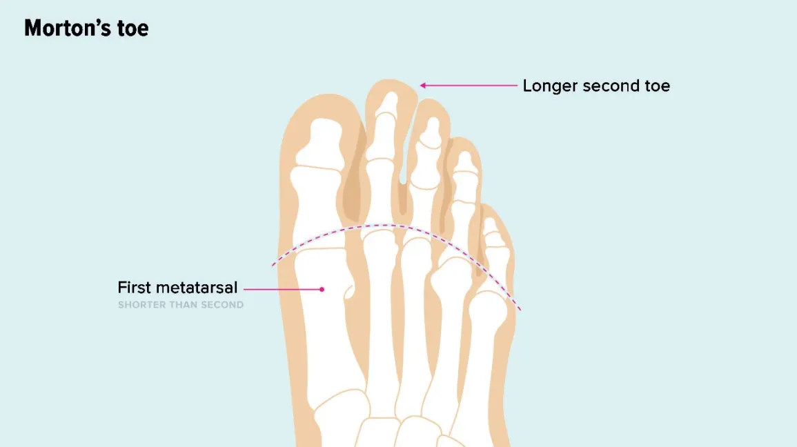 Morton’s toe