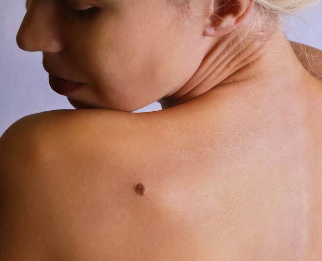 What does the shape of your birthmark mean?