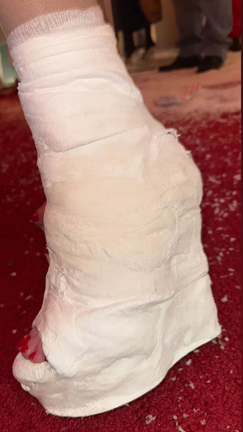 Kim Kardashian shares new photo of her foot cast to her Instagram Stories.