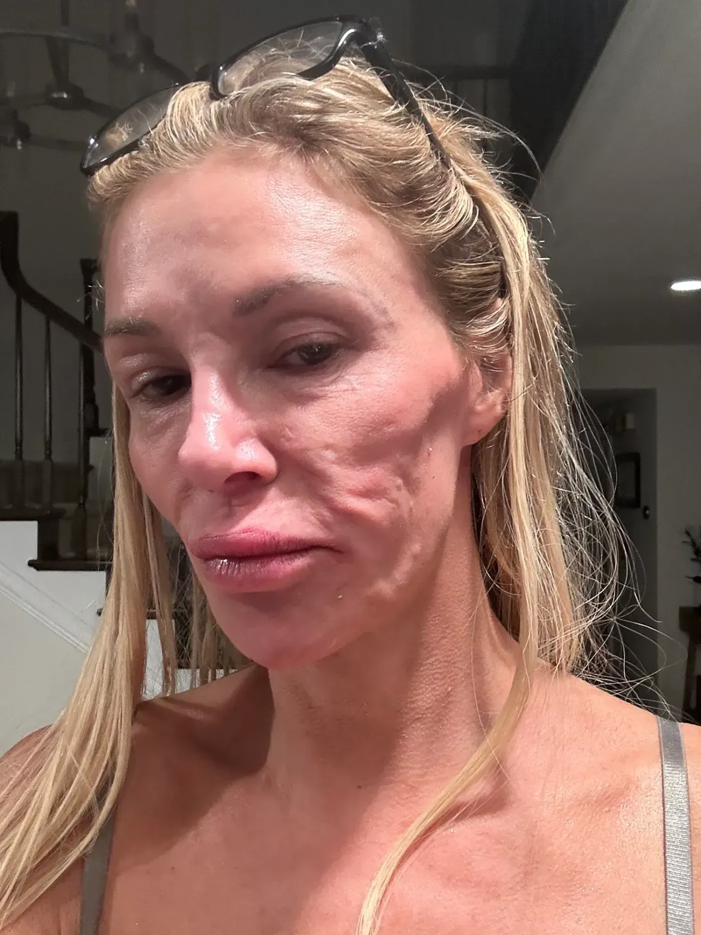 Brandi Glanville Addresses the Impact of Facial Deformity on Her Life