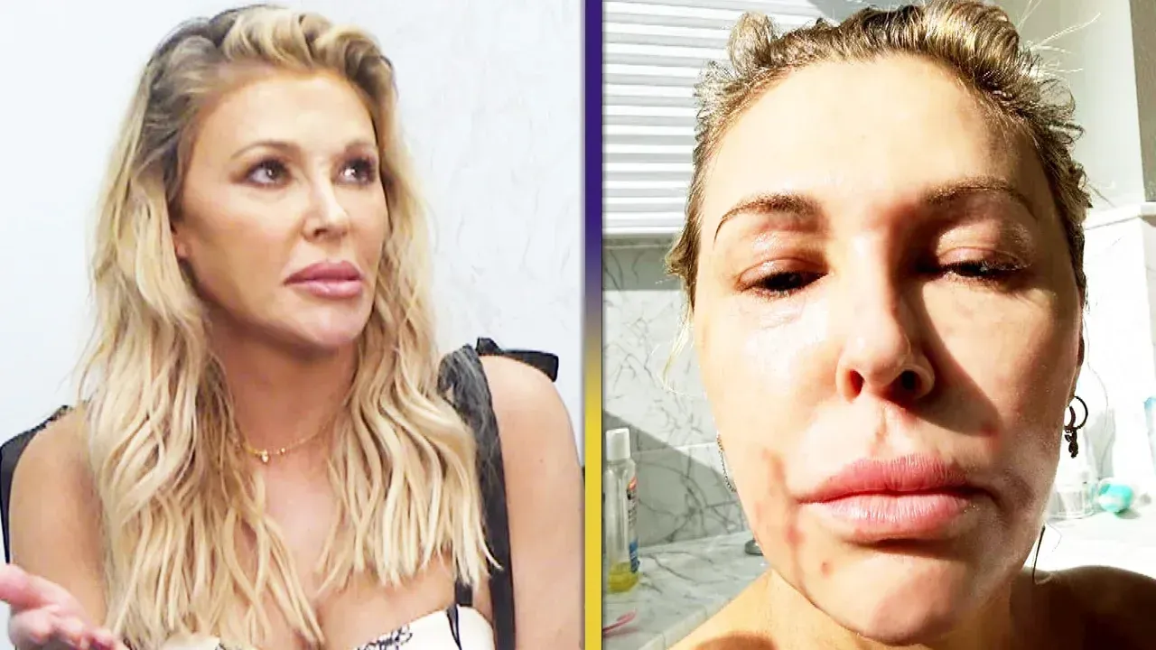 Brandi Glanville Addresses the Impact of Facial Deformity on Her Life