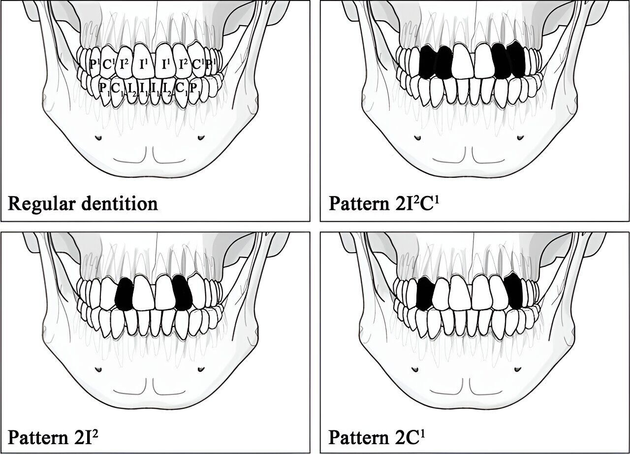 Tooth ablation patterns