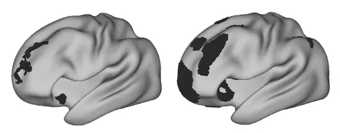 Brain Network Linked to Attention Larger in Individuals with Depression