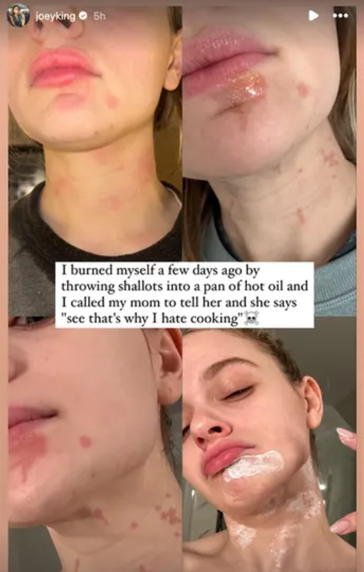 Joey King Suffered Facial Burns in a Kitchen Accident