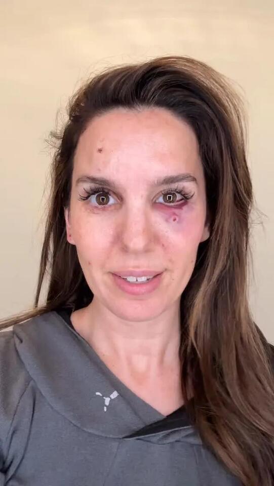 Christy Carlson Romano Hospitalized After Eye Injury