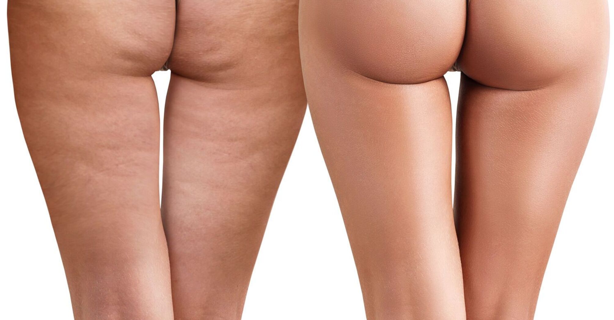 How to reduce cellulite and improve skin condition
