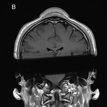 Man Develops 'Headspin Hole' After Decades of Breakdancing