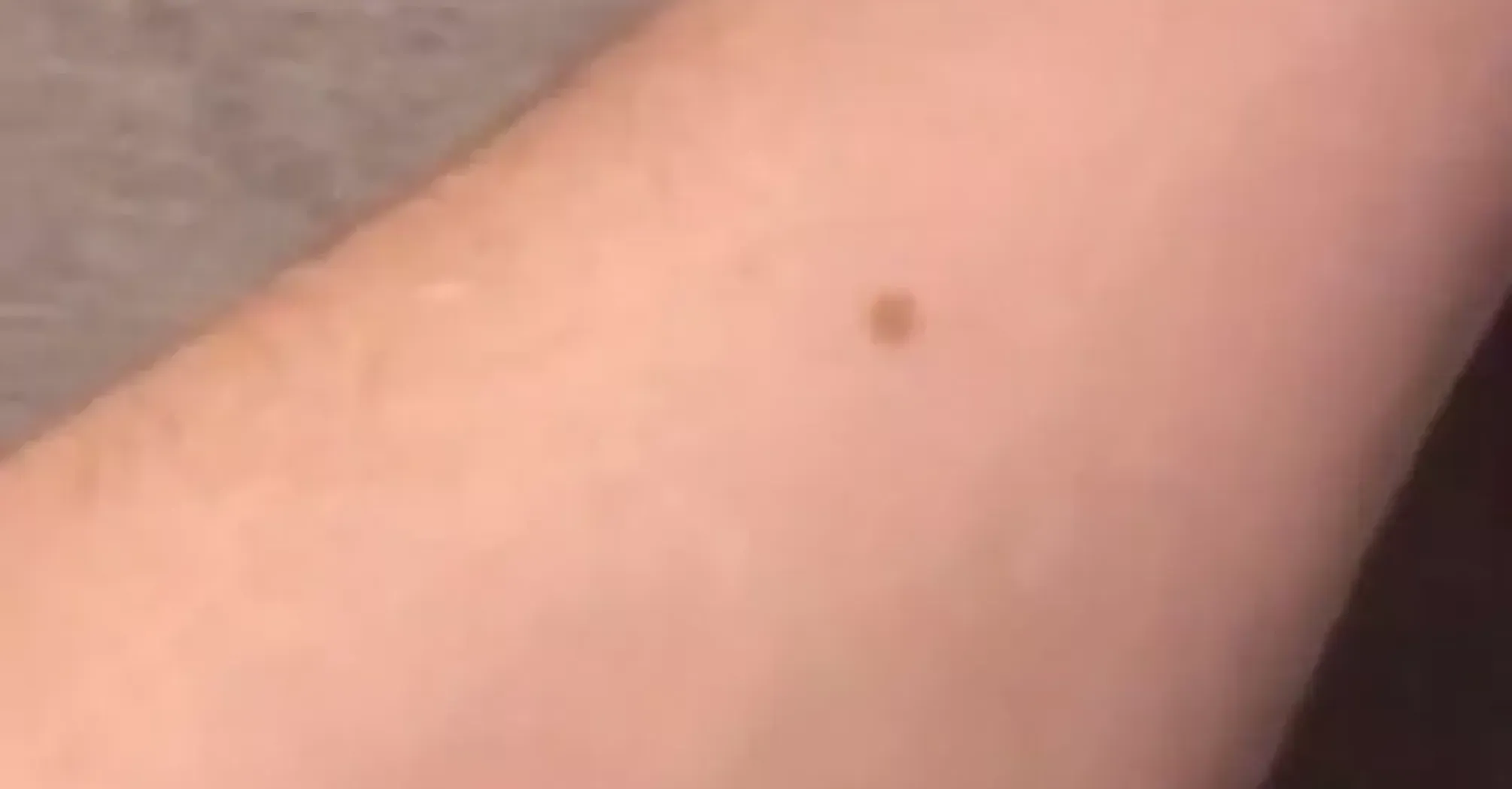 The Freckle Theory: All Guys Have Freckle In Same Place