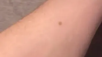 The Freckle Theory: All Guys Have Freckle In Same Place