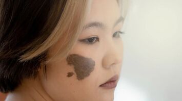 Birthmark