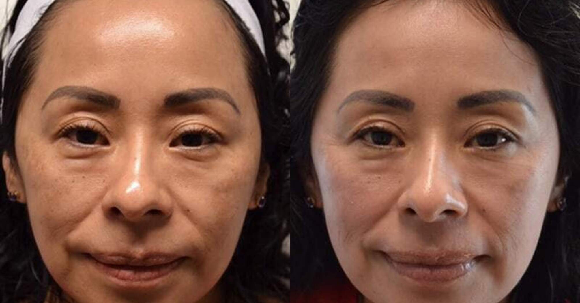 What is an acid peel for the face