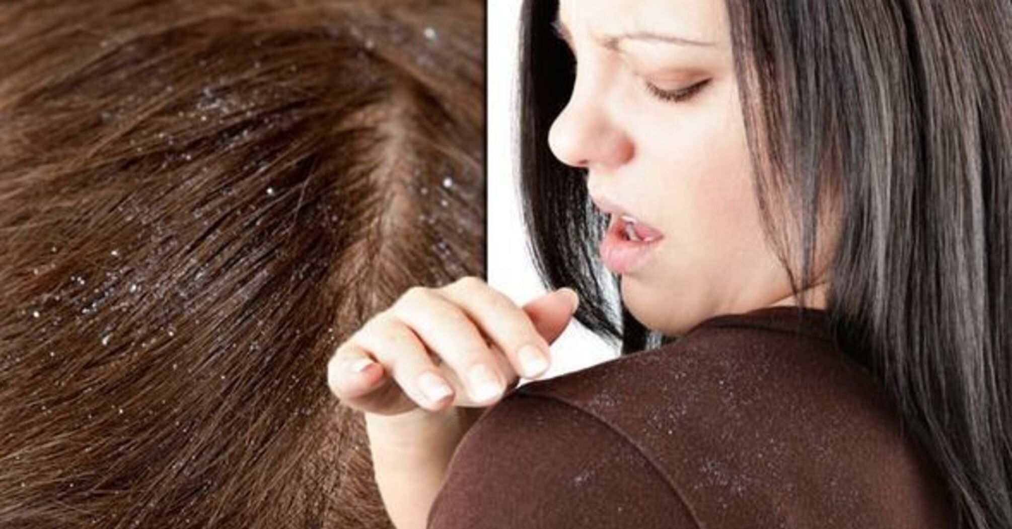 How to get rid of dandruff quickly