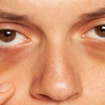 How to quickly get rid of dark circles under the eyes