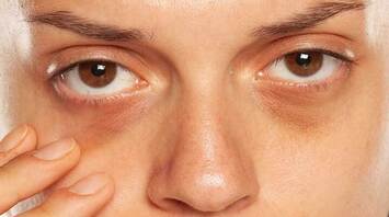 How to quickly get rid of dark circles under the eyes