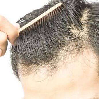 How to reduce hair loss