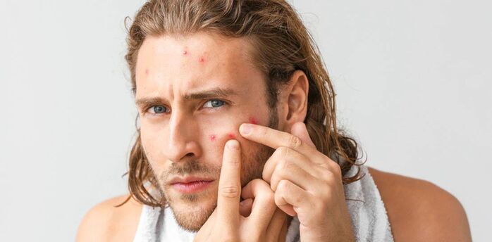 How to remove a pimple overnight