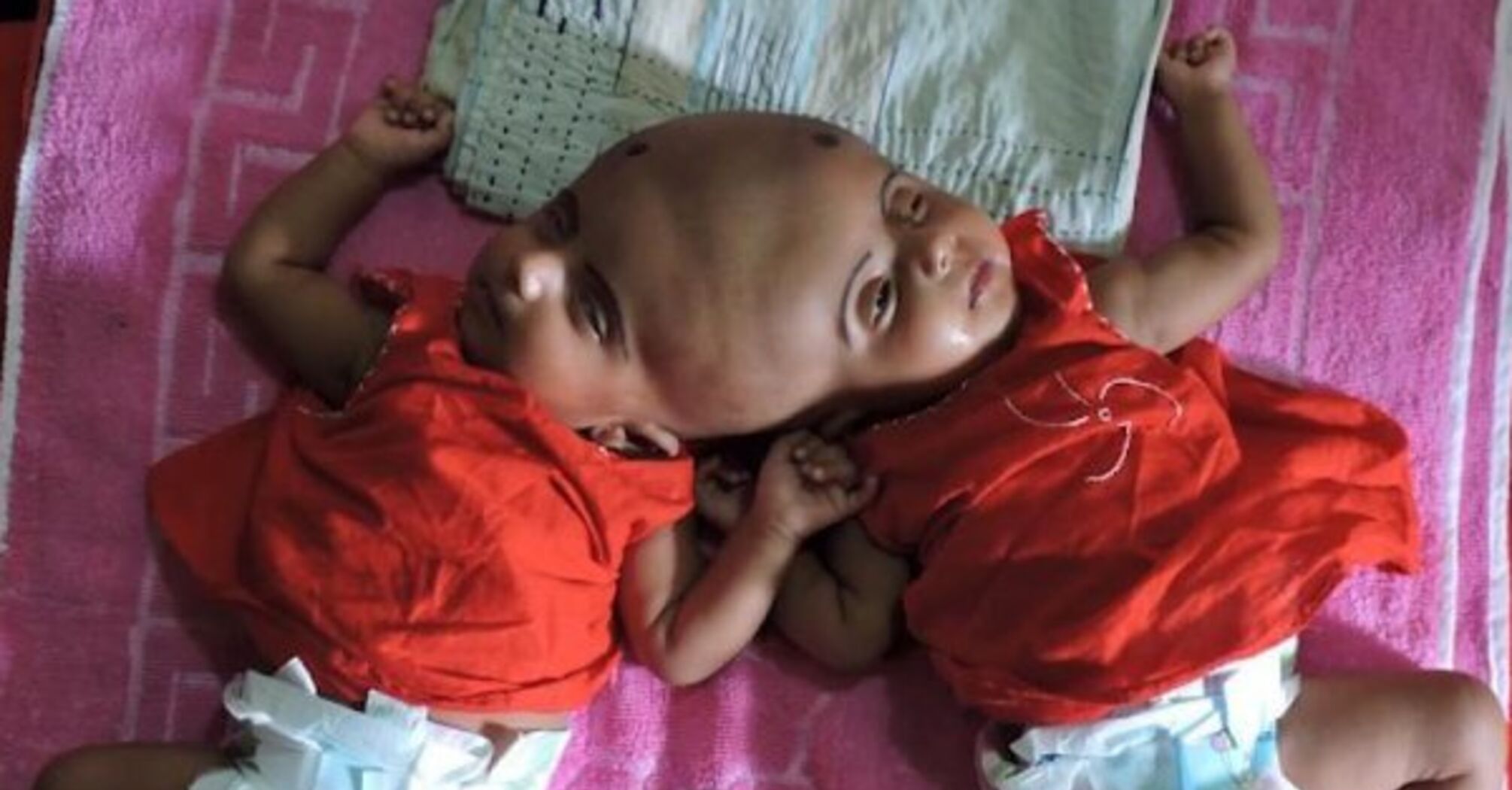 Siamese twins share what will happen to the other if one of them dies