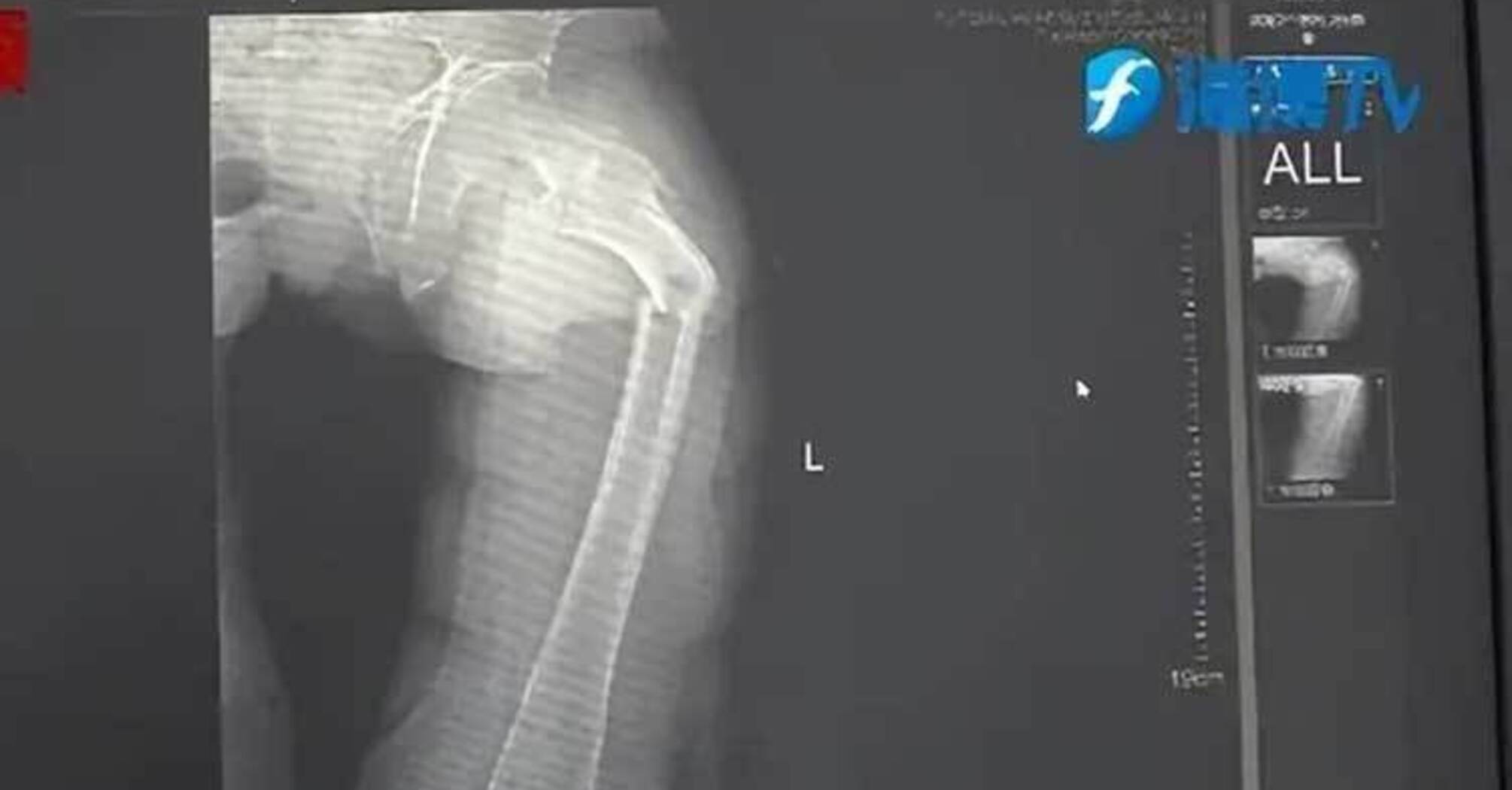 35-year-old man breaks hardest bone in the human body while coughing