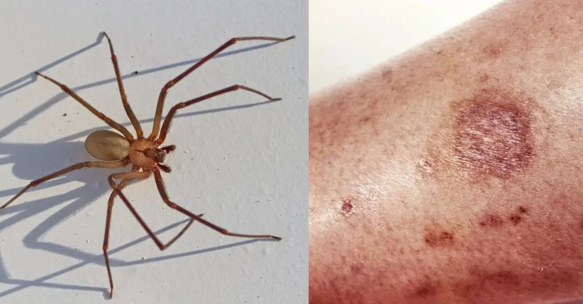 What a poisonous spider bite looks like