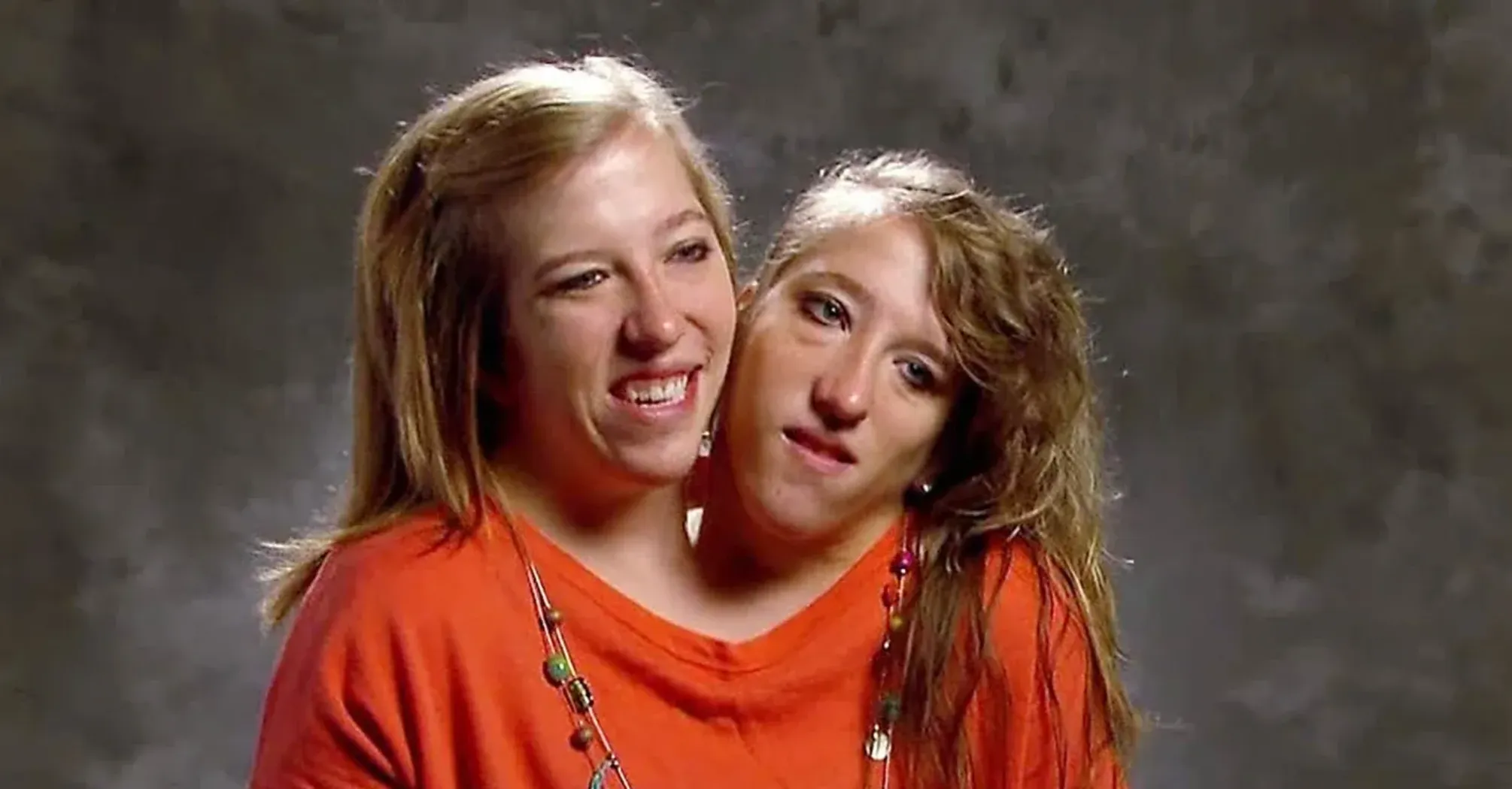 Conjoined Twins Abby and Brittany Hensel Explain Their Unique Anatomy