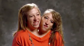 Conjoined Twins Abby and Brittany Hensel Explain Their Unique Anatomy