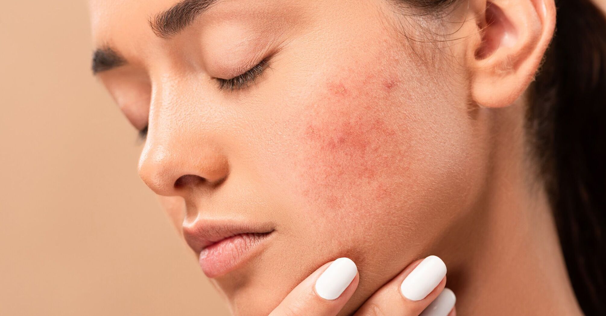 Understanding the Dream Meaning of Acne