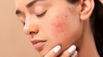 Understanding the Dream Meaning of Acne