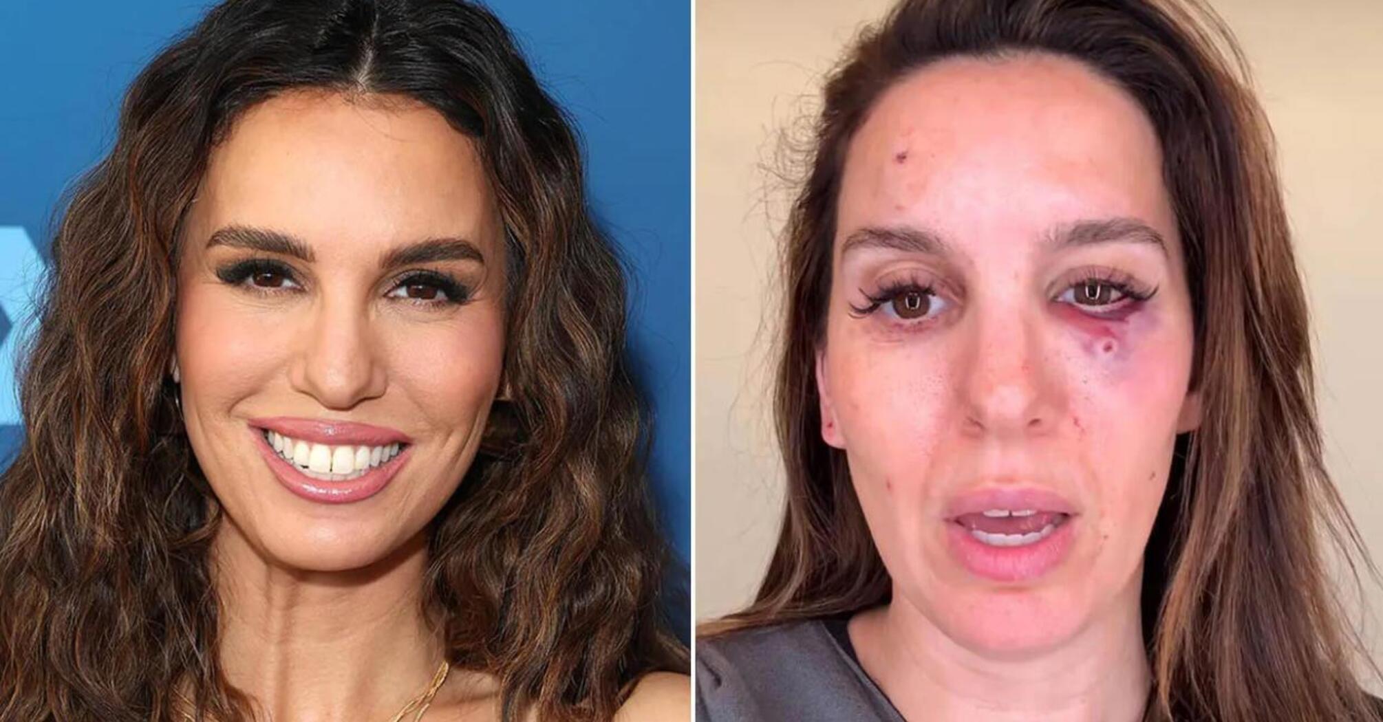 Christy Carlson Romano Hospitalized After Eye Injury