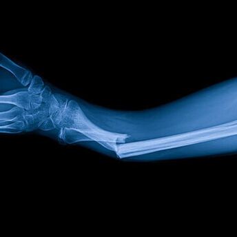 The Spiritual Meaning of a Broken Arm: Lessons in Strength and Transformation