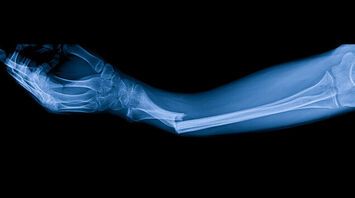 The Spiritual Meaning of a Broken Arm: Lessons in Strength and Transformation